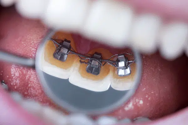 braces-for-adults-mt-airy-pa braces-for-adults-mt-airy-pa
