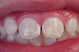Teeth w White Spots