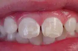 Teeth w White Spots Teeth w White Spots