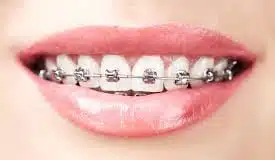 braces philadelphia-pennsylvania braces philadelphia-pennsylvania