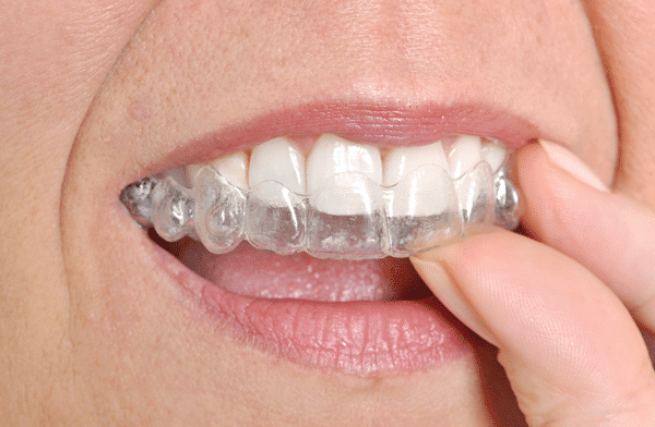 person-putting-in-Invisalign-clear-aligners