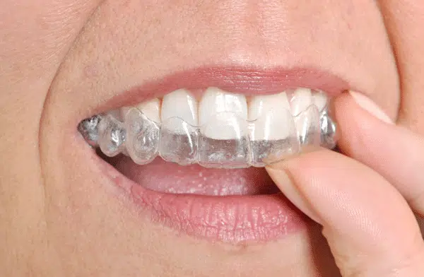 person-putting-in-Invisalign-clear-aligners person-putting-in-Invisalign-clear-aligners