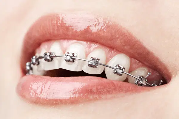 close-up-smile-with-braces close-up-smile-with-braces