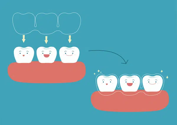 invisalign illustration invisalign illustration