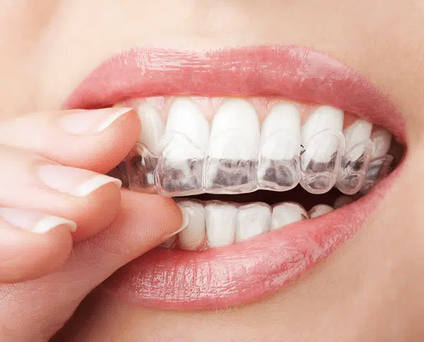 invisalign vs. smile direct club pa invialign vs. smile direct club pa