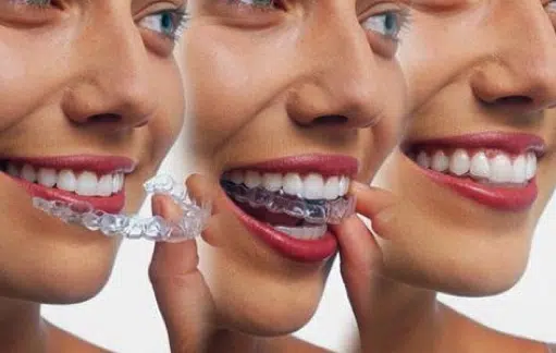 how-to-make-invisalign-more-comfortable-philadelphia-pa how to make invisalign more comfortable philadelphia pa