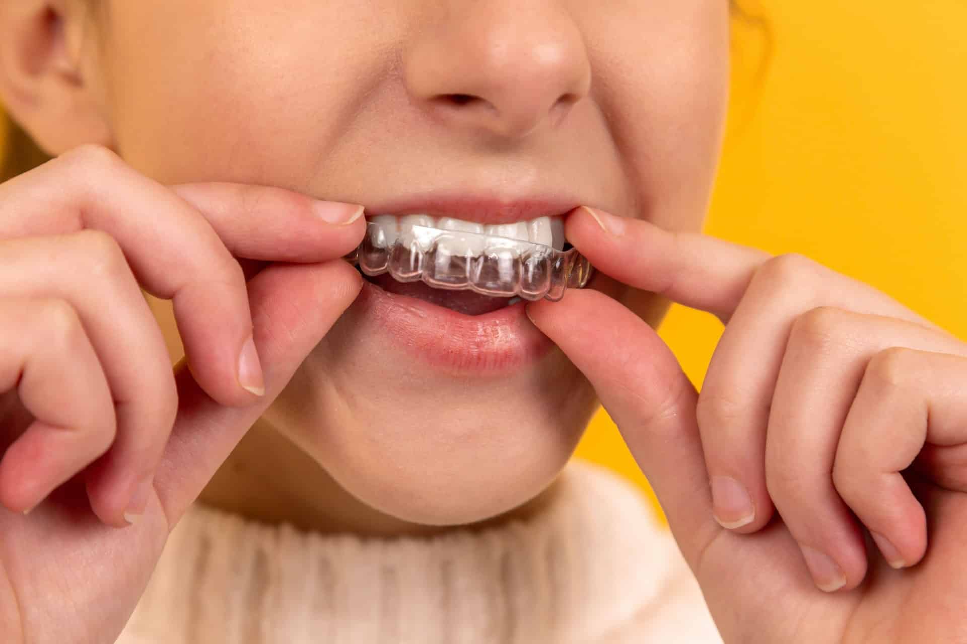 Braces vs. Invisalign: Which Wins in Orthodontic Treatment?