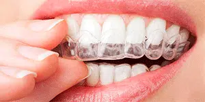 Clear Retainers