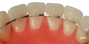 Fixed Retainers