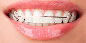 Hawley Retainers