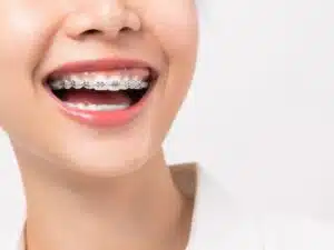 Braces Philadelphia