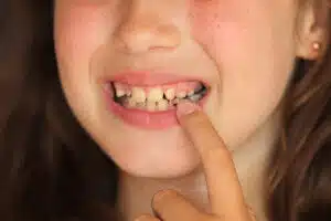 early orthodontic evaluation
