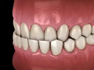 orthodontic problems including underbites and misaligned teeth