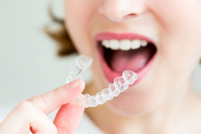 Confident Smile Guide: Why Clear Braces Are the Smart Choice