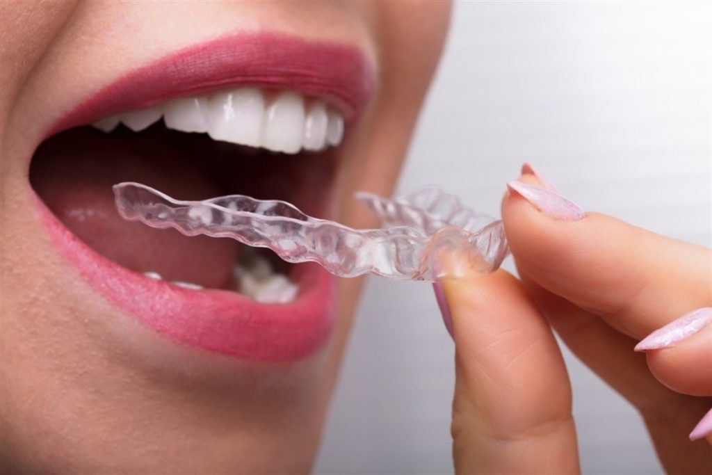 Invisalign Timeline: How Long Will Your Treatment Really Take?