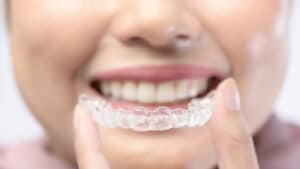 Science Behind Invisalign: Why It’s the Future of Teeth Alignment