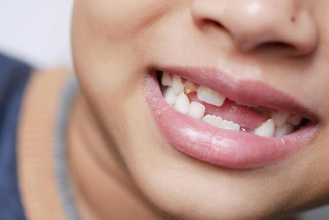 Early Orthodontic Treatment Advantages That Can’t Be Ignored