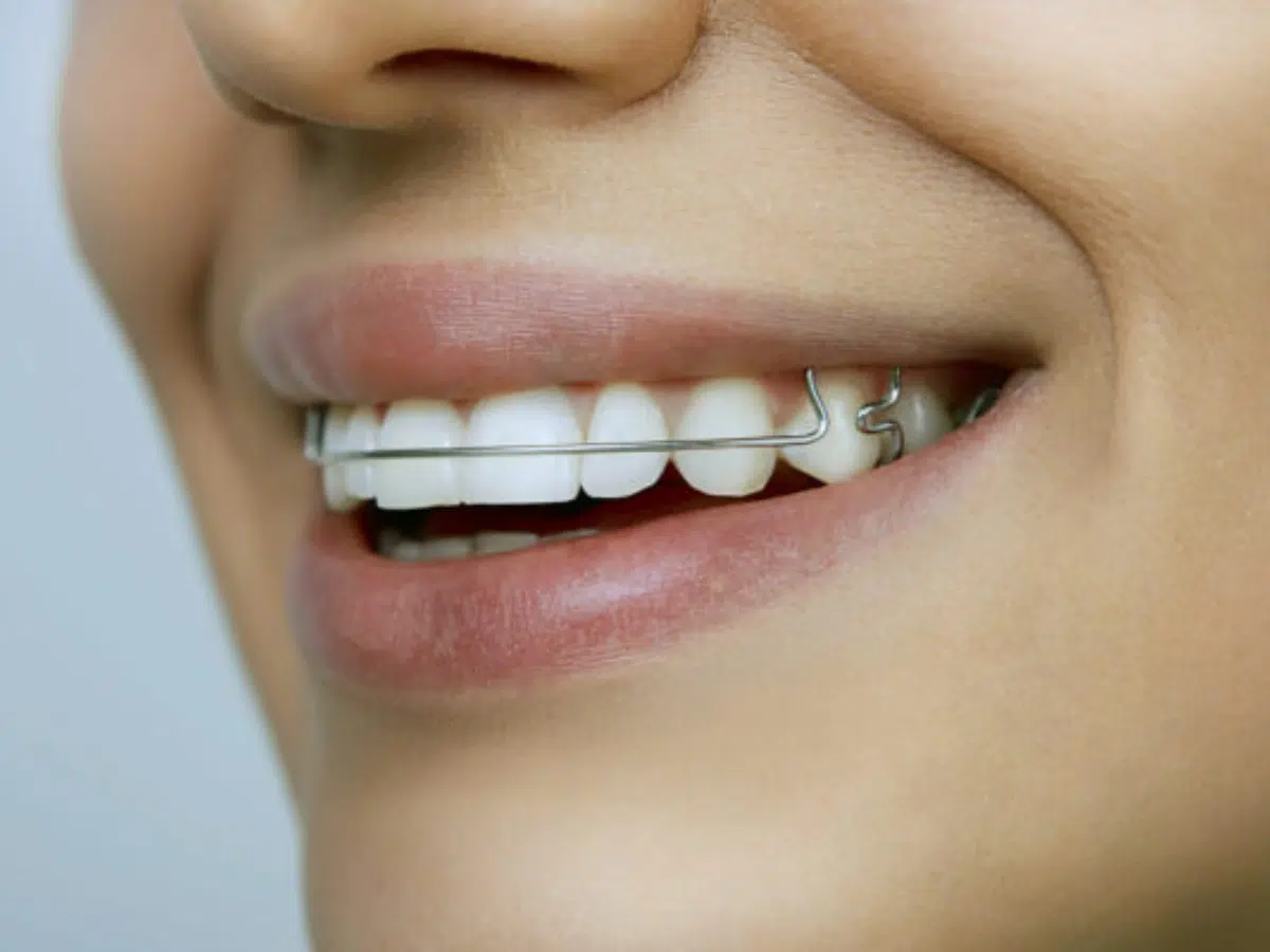 closeup of clear retainer after braces removal