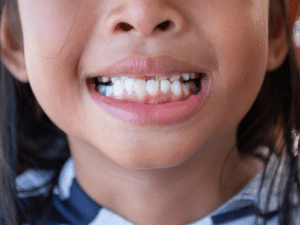 Close-up of a child’s teeth showing spacing issues addressed with phase 1 orthodontic treatment