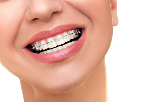 Close-up smile showing clear braces that reflect the adult orthodontic treatment trend in modern orthodontic care
