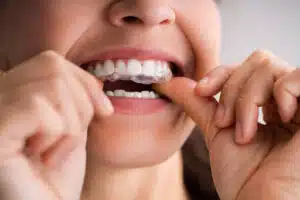 Adult placing a clear aligner tray, showing how clear aligners for adults fit daily orthodontic treatment