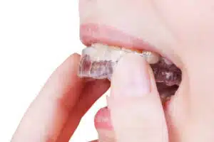 Patient placing removable tray on teeth demonstrating a clear aligner comparison for adult orthodontic care