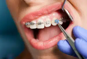 Orthodontist adjusting braces on patient while discussing Spark clear aligners benefits and treatment options
