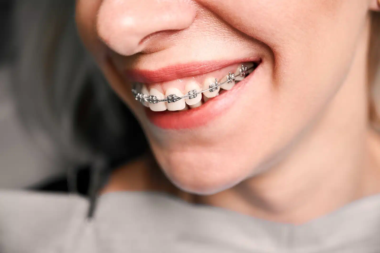 Germantown patient smiling with Damon braces at Farrow Orthodontics Philadelphia