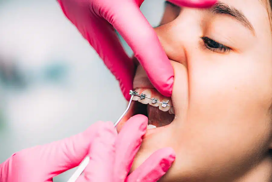 Chestnut Hill patient smiling with braces at Farrow Orthodontics Philadelphia