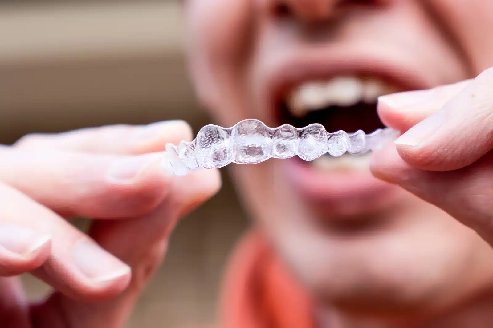 Man placing clear aligners over his teeth