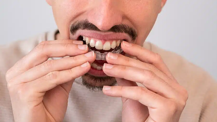 Young Man Adjusting And Placing Invisible Silicone Aligner For Dental Correction
