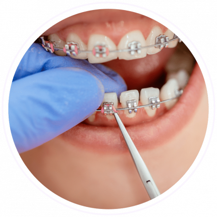 early orthodontic treatment philadelphia